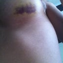 Bruise that randomly came up on left and freaked me out