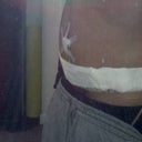 Post op Day 5 (side view) - This was taken in the evening when I'm more swollen