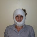 the new rooster look - day after surgery