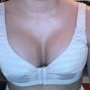 This is on Day 7 , surgery was on 3/21.