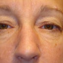 Before, notice right eye (my left) very baggy which got in the way of my sight.