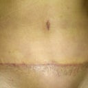 3 weeks post op (first post op pic I dared to snap)