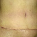 4 weeks post op (a little less swollen than 3 weeks)