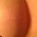 Breast lift scar 1 year post surgery