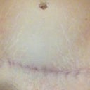 TT scar 1 year post surgery