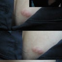 Scar by an extirpation of a Fibroadenoma from my left breast