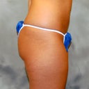 Buttock Implants