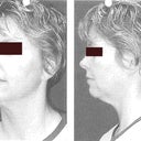 Before the procedure