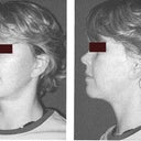After the procedure