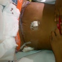 7 hours post op in Hotel room