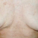 Post Explant Dec.2008.As you can see,my left breast only got worse as it began to settle.The nipple completely turned down & was painful. The right breast began puckering & indenting even more. The scars under the nipples never did heal well. Big indented red scars.
