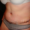 So weird to see a flat belly - despite the swelling that is still there!