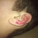 This is my left ear, which is redder and more rough than my right ear, they are oily from the 'Scar Fade' cream I put on them at night