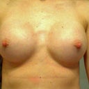 5 weeks post op