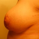 side shot, just to see the side. love my new boobs!
