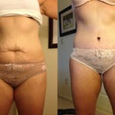 One week post op