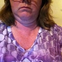 double chin 3.5 months after procedure