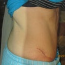 37 days po (the scar is high)