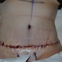 1 day post-op.  Its hard to believe this is a photo of me!