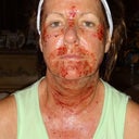 Right after I got home from the procedure. You can see where Dr. Nik was more aggressive at problematic areas.