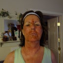 The next day. Swelling is beginning. I go back to the doctor for a one day check-up today. Doctor says all is well.