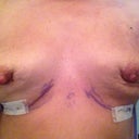 21-hrs post-removal closer up.