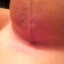 Left incision