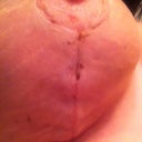 Right incision