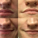 Before and after Radiesse NL FOLDS