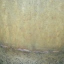 Recent picture of my incision.  Very thin low and this only one month.  In 6 months I'm sure it will look great.