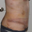 10 days PO - that weird red band going from my side incision around to the front is just from my wrap/garmet thingie
