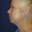 Before - left