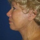 After - left