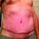 Post Op Week 3