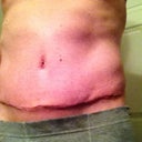 Post Op Week 3