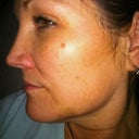 This was taken a week prior to my first treatment.  I definitely have some spots that need taken care of.