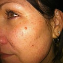 The morning after my first treatment.  You can see how the spots got much darker.