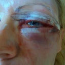 day after surgery
