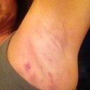 Day 1 after alternating ice.