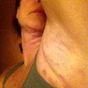 Day 1 bruising and swelling
