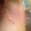 Day 2 bruising and swelling decreased.