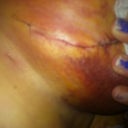 Incisions