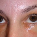 Hyaluronidase and Steroid injections - May 2012