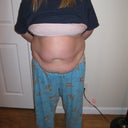 BEFORE SMART LIPO
