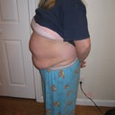 BEFORE SMART LIPO
