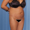 Before - ugly stretch marks and after-birth loose skin
