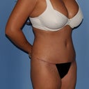 After - stretch marks are gone and skin is tight and youthful