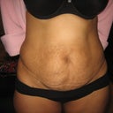 day before my surgery