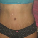 5 weeks post op