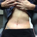 2 Days Post Op